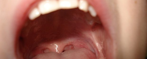 Remedio casero llagas en la lengua